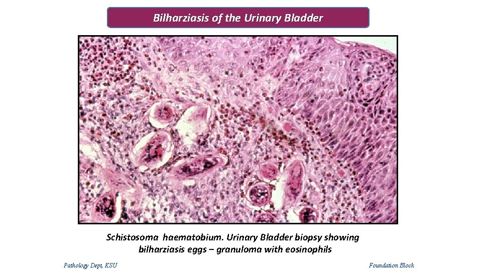 Bilharziasis of the Urinary Bladder Schistosoma haematobium. Urinary Bladder biopsy showing bilharziasis eggs – Bilharziasis of the Urinary Bladder Schistosoma haematobium. Urinary Bladder biopsy showing bilharziasis eggs –