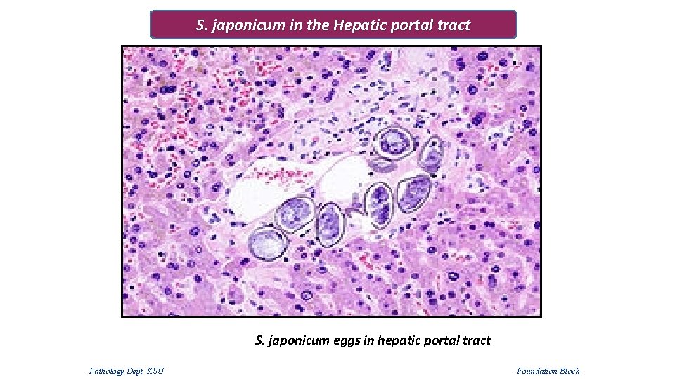 S. japonicum in the Hepatic portal tract S. japonicum eggs in hepatic portal tract S. japonicum in the Hepatic portal tract S. japonicum eggs in hepatic portal tract