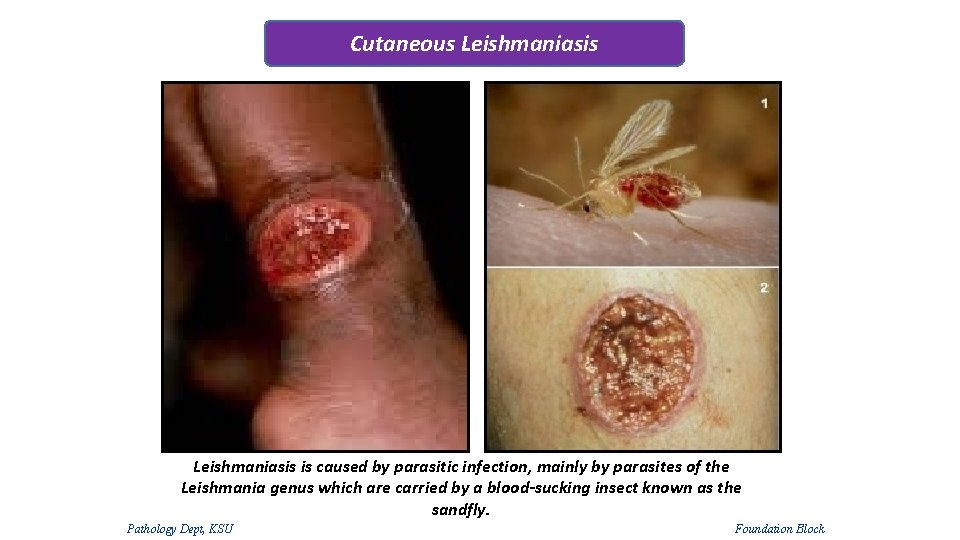 Cutaneous Leishmaniasis is caused by parasitic infection, mainly by parasites of the Leishmania genus Cutaneous Leishmaniasis is caused by parasitic infection, mainly by parasites of the Leishmania genus