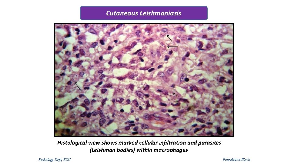 Cutaneous Leishmaniasis Histological view shows marked cellular infiltration and parasites (Leishman bodies) within macrophages Cutaneous Leishmaniasis Histological view shows marked cellular infiltration and parasites (Leishman bodies) within macrophages