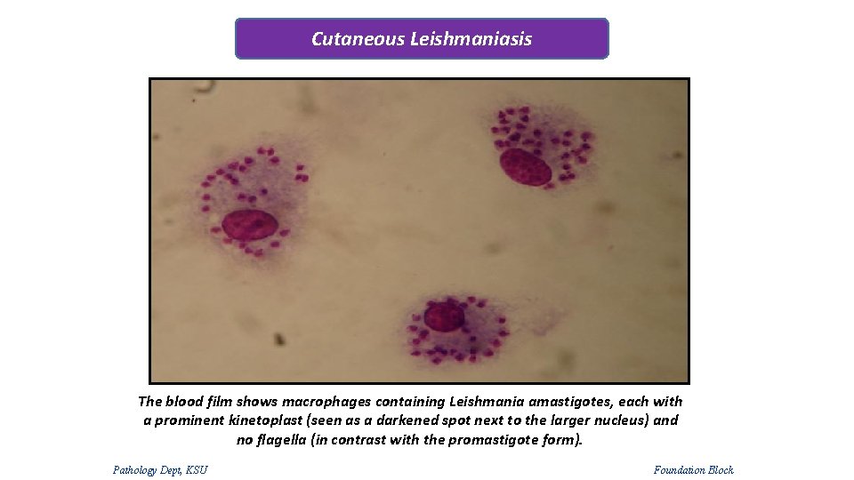 Cutaneous Leishmaniasis The blood film shows macrophages containing Leishmania amastigotes, each with a prominent Cutaneous Leishmaniasis The blood film shows macrophages containing Leishmania amastigotes, each with a prominent
