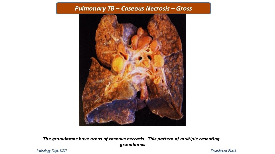 Pulmonary TB – Caseous Necrosis – Gross The granulomas have areas of caseous necrosis. Pulmonary TB – Caseous Necrosis – Gross The granulomas have areas of caseous necrosis.