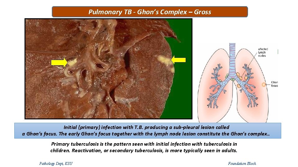 Pulmonary TB - Ghon’s Complex – Gross Initial (primary) infection with T. B. producing Pulmonary TB - Ghon’s Complex – Gross Initial (primary) infection with T. B. producing