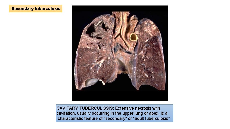 Secondary tuberculosis CAVITARY TUBERCULOSIS: Extensive necrosis with cavitation, usually occurring in the upper lung Secondary tuberculosis CAVITARY TUBERCULOSIS: Extensive necrosis with cavitation, usually occurring in the upper lung