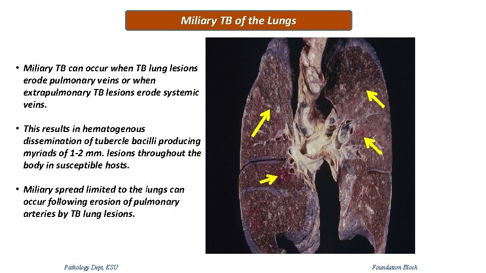 Miliary TB of the Lungs • Miliary TB can occur when TB lung lesions Miliary TB of the Lungs • Miliary TB can occur when TB lung lesions