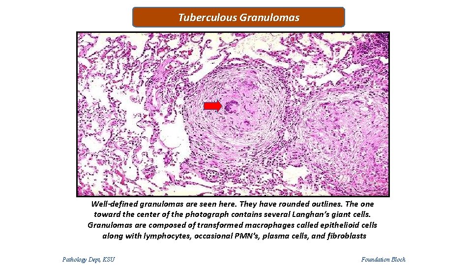 Tuberculous Granulomas Well-defined granulomas are seen here. They have rounded outlines. The one toward Tuberculous Granulomas Well-defined granulomas are seen here. They have rounded outlines. The one toward