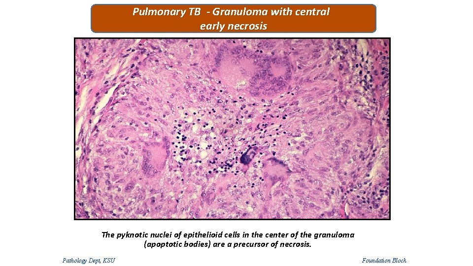 Pulmonary TB - Granuloma with central early necrosis The pyknotic nuclei of epithelioid cells Pulmonary TB - Granuloma with central early necrosis The pyknotic nuclei of epithelioid cells