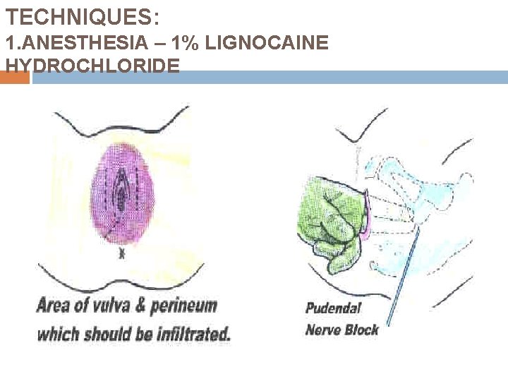 TECHNIQUES: 1. ANESTHESIA – 1% LIGNOCAINE HYDROCHLORIDE 