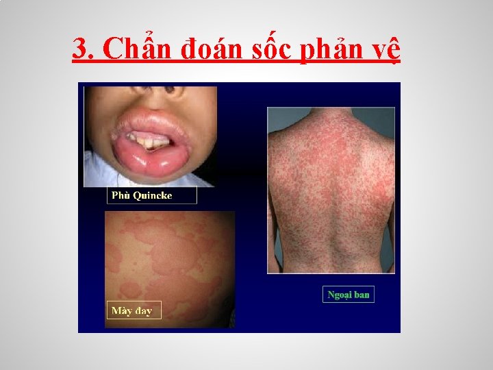 3. Chẩn đoán sốc phản vệ 