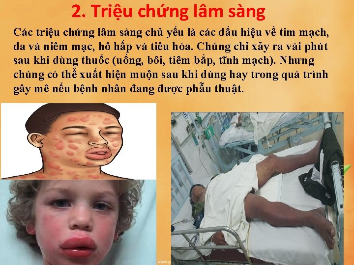 2. Triệu chứng lâm sàng Các triệu chứng lâm sàng chủ yếu là các