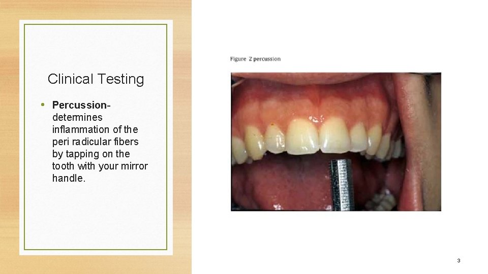 Clinical Testing • Percussiondetermines inflammation of the peri radicular fibers by tapping on the