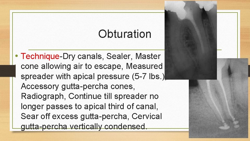 Obturation • Technique-Dry canals, Sealer, Master cone allowing air to escape, Measured spreader with