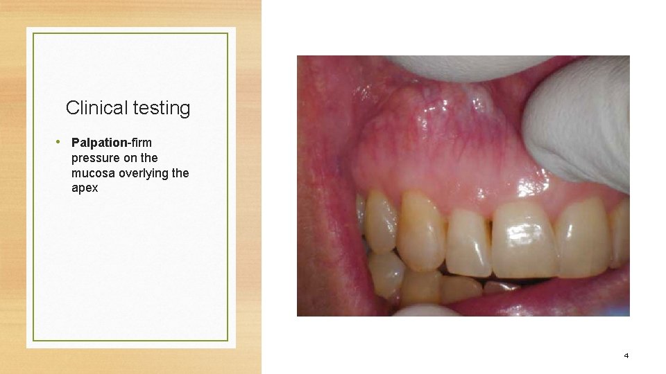 Clinical testing • Palpation-firm pressure on the mucosa overlying the apex 4 