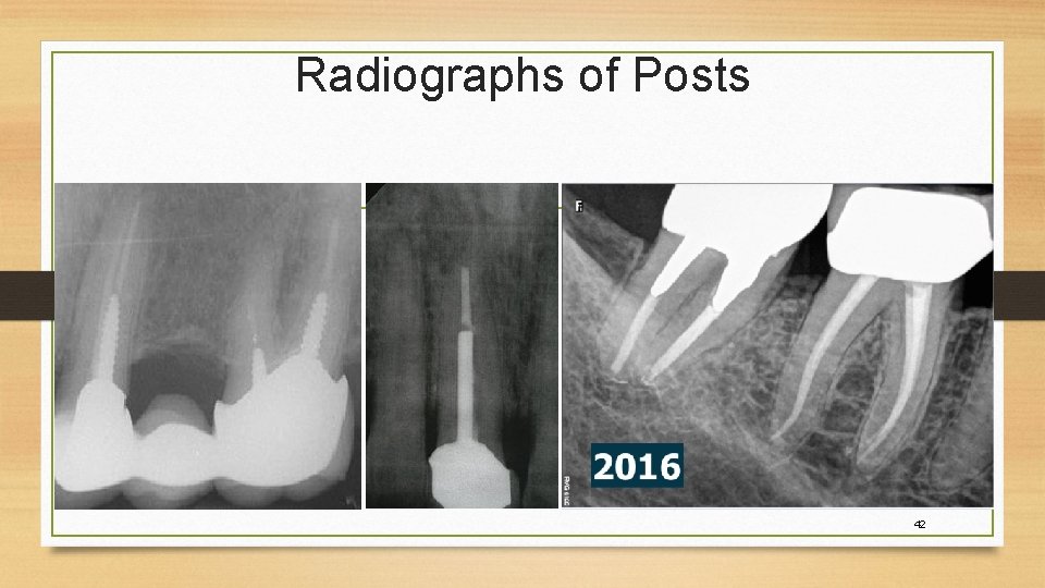 Endodontics AKA Root Canal Therapy RCT 1 Describe