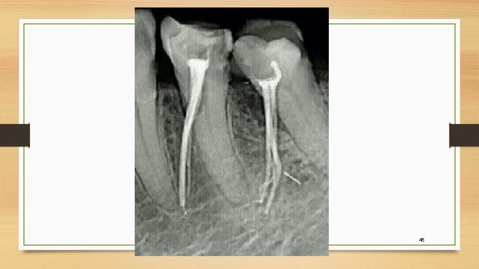Endodontics AKA Root Canal Therapy RCT 1 Describe