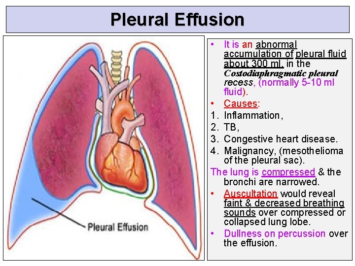 Pleural Effusion • It is an abnormal accumulation of pleural fluid about 300 ml,