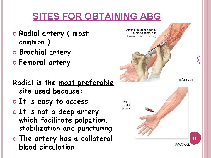 SITES FOR OBTAINING ABG Radial artery ( most common ) Brachial artery Femoral artery