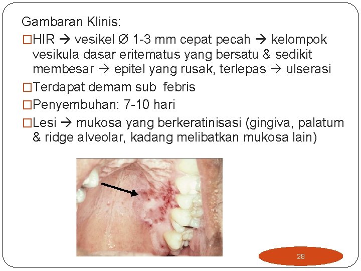 Gambaran Klinis: �HIR vesikel Ø 1 -3 mm cepat pecah kelompok vesikula dasar eritematus