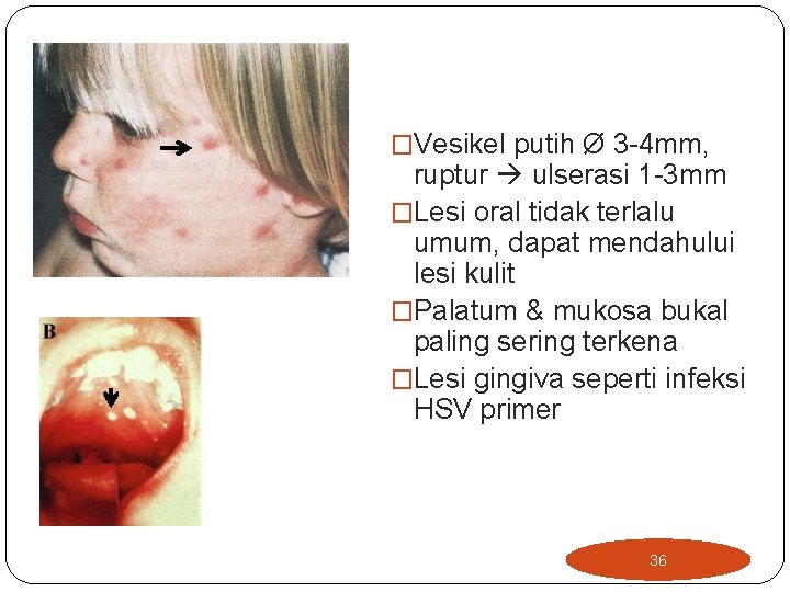 �Vesikel putih Ø 3 -4 mm, ruptur ulserasi 1 -3 mm �Lesi oral tidak