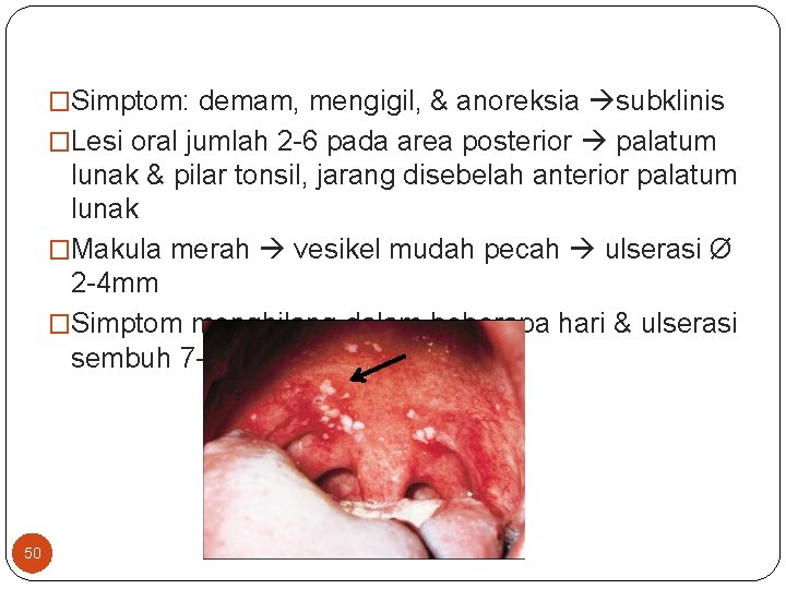 �Simptom: demam, mengigil, & anoreksia subklinis �Lesi oral jumlah 2 -6 pada area posterior