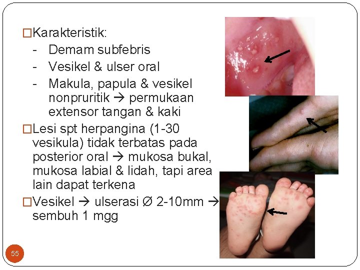 �Karakteristik: - Demam subfebris - Vesikel & ulser oral - Makula, papula & vesikel