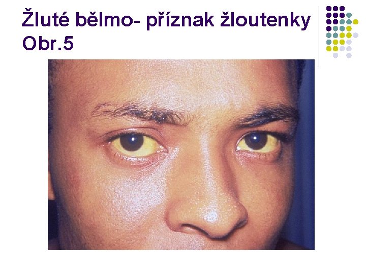 Žluté bělmo- příznak žloutenky Obr. 5 