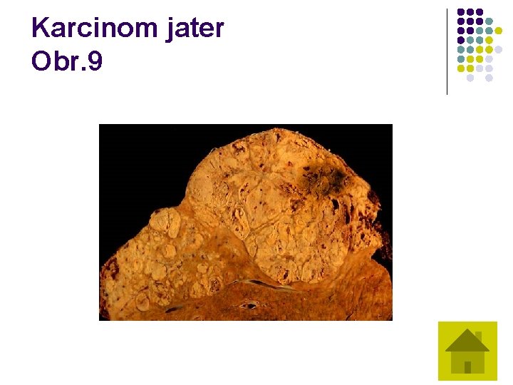 Karcinom jater Obr. 9 