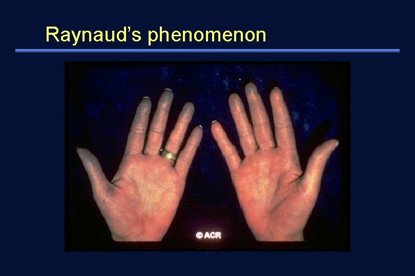 Raynaud’s phenomenon 