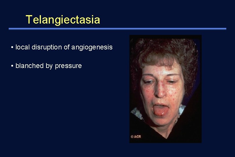 Telangiectasia • local disruption of angiogenesis • blanched by pressure 