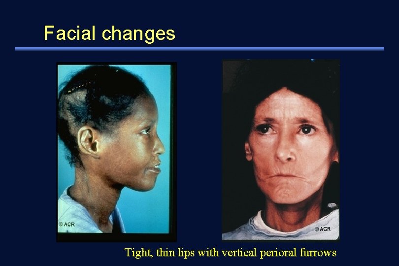 Facial changes Tight, thin lips with vertical perioral furrows 