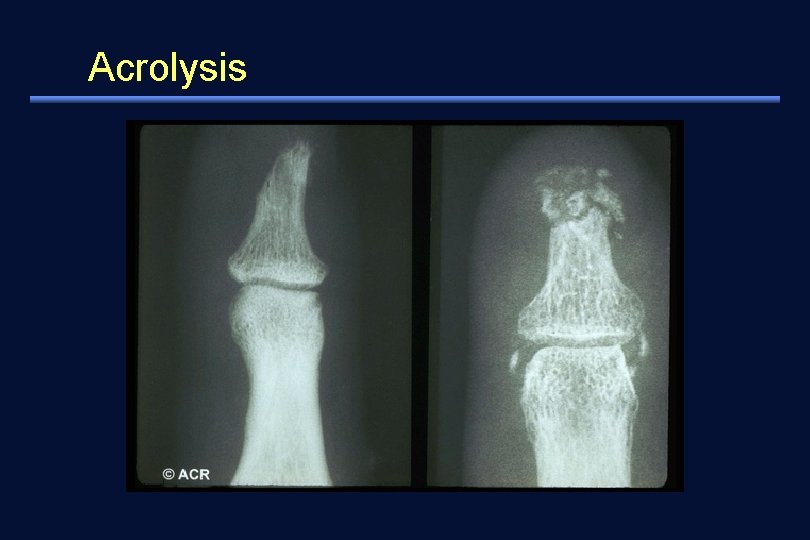 Acrolysis 