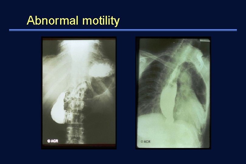 Abnormal motility 