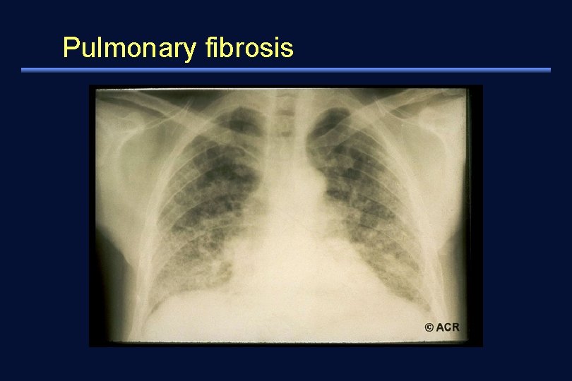 Pulmonary fibrosis 