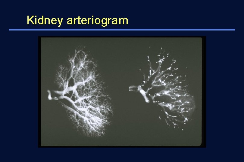 Kidney arteriogram 