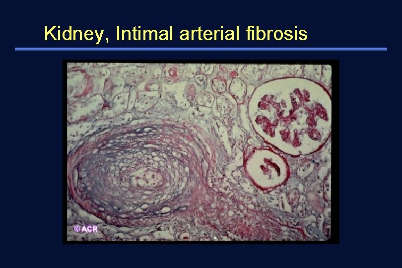 Kidney, Intimal arterial fibrosis 