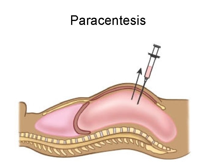 Paracentesis 