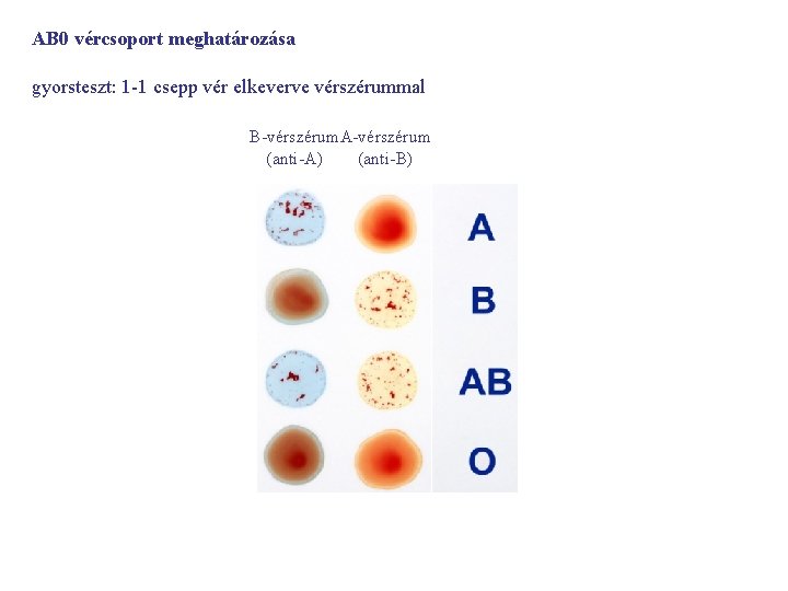 AB 0 vércsoport meghatározása gyorsteszt: 1 -1 csepp vér elkeverve vérszérummal B-vérszérum. A-vérszérum (anti-A)