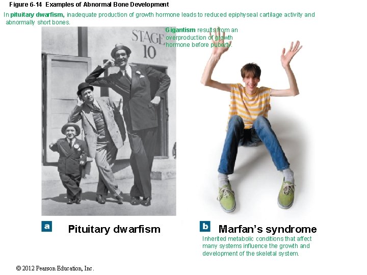 Figure 6 -14 Examples of Abnormal Bone Development In pituitary dwarfism, inadequate production of
