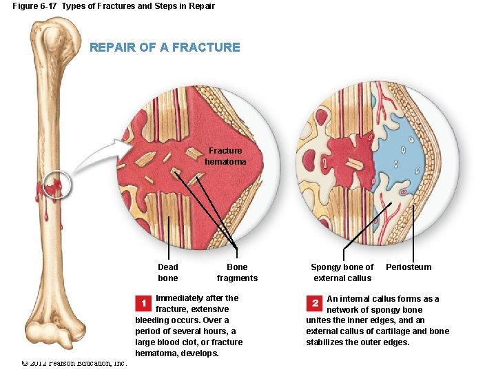 Figure 6 -17 Types of Fractures and Steps in Repair REPAIR OF A FRACTURE