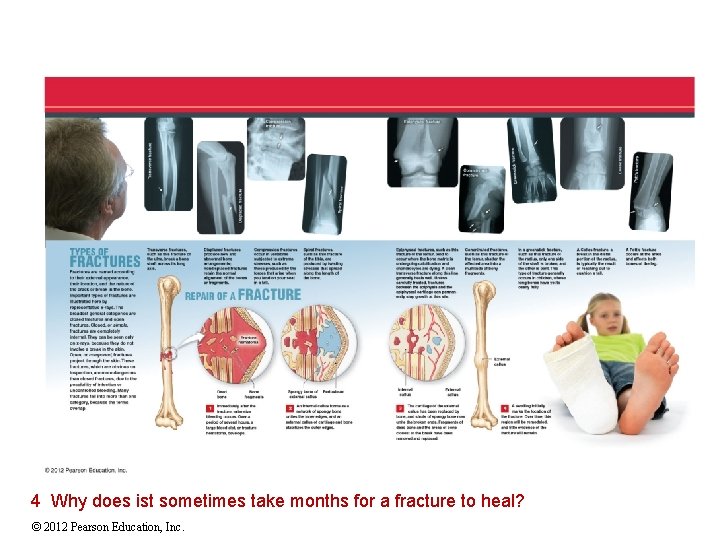 4 Why does ist sometimes take months for a fracture to heal? © 2012