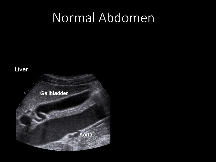 Normal Abdomen Liver Gallbladder Aorta 