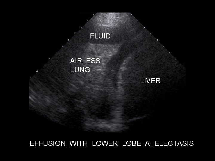 FLUID AIRLESS LUNG LIVER EFFUSION WITH LOWER LOBE ATELECTASIS 