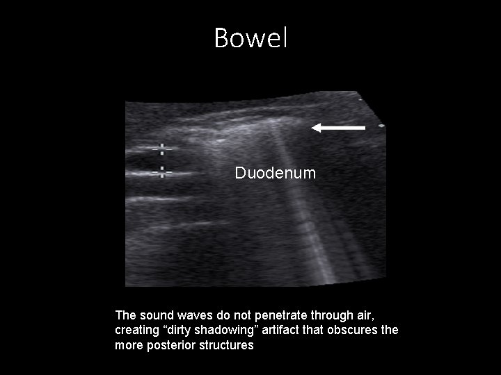 Bowel Duodenum The sound waves do not penetrate through air, creating “dirty shadowing” artifact