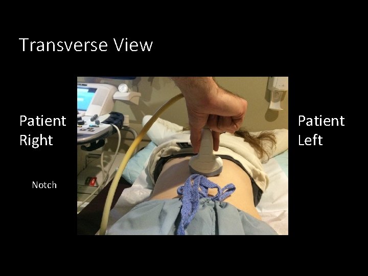 Transverse View Patient Right Notch Patient Left 