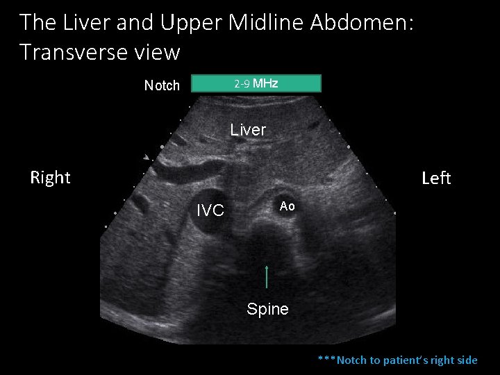 The Liver and Upper Midline Abdomen: Transverse view 2 -9 MHz Notch Liver Right