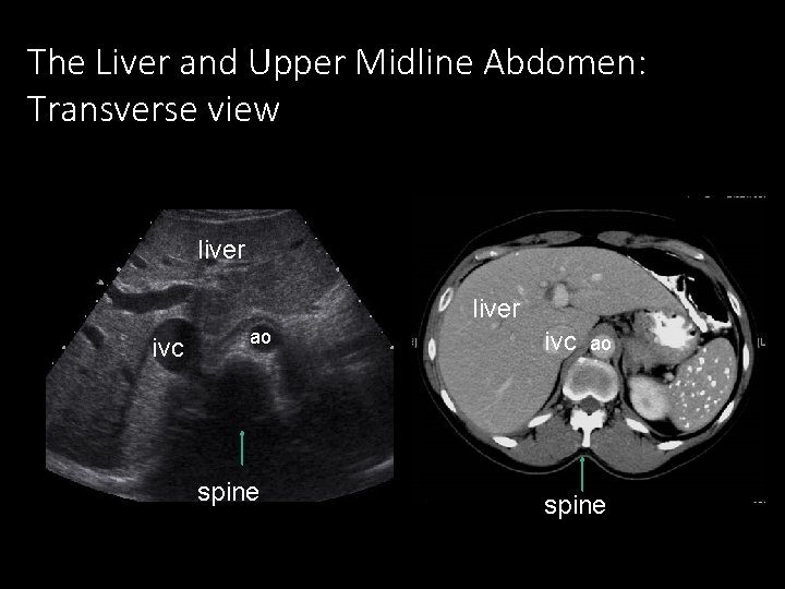 The Liver and Upper Midline Abdomen: Transverse view liver ivc ao spine 