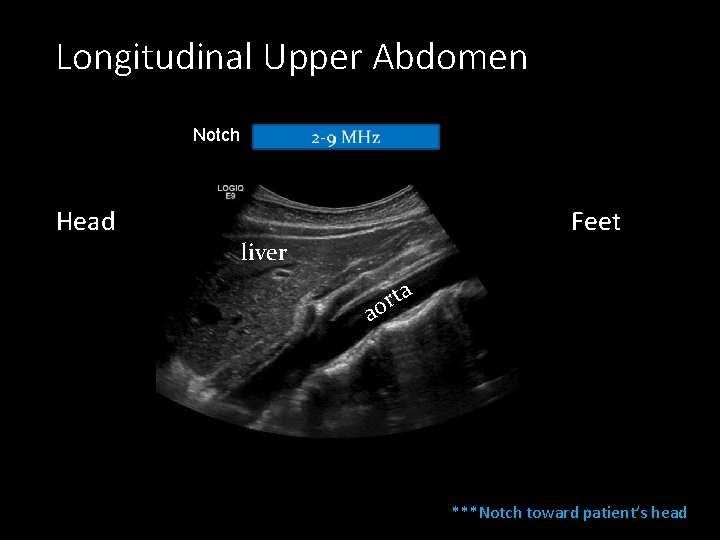 Longitudinal Upper Abdomen Notch Head Feet liver ta r o a ***Notch toward patient’s