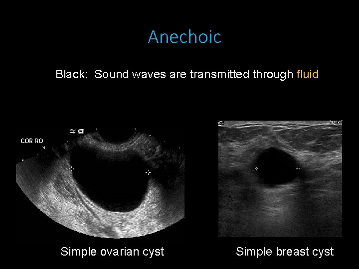 Anechoic Black: Sound waves are transmitted through fluid Simple ovarian cyst Simple breast cyst