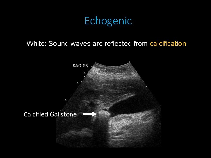Echogenic White: Sound waves are reflected from calcification Calcified Gallstone 