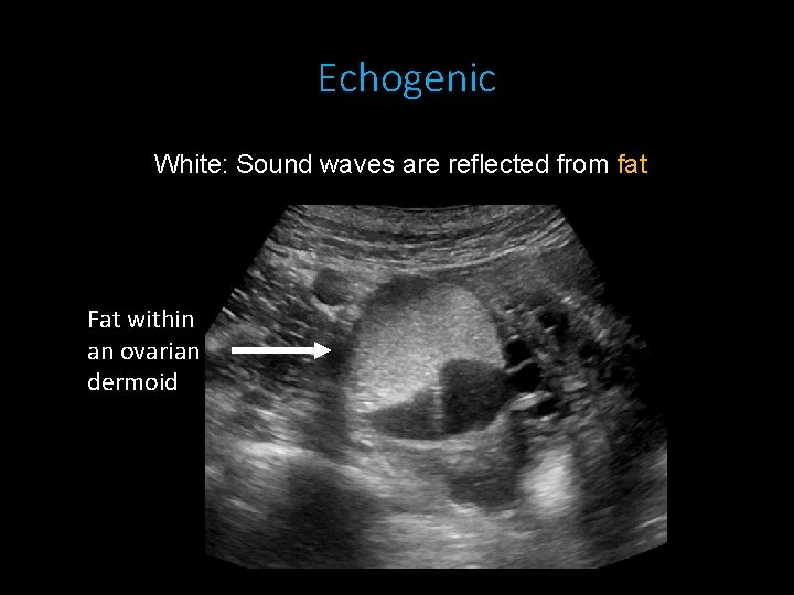 Echogenic White: Sound waves are reflected from fat Fat within an ovarian dermoid 